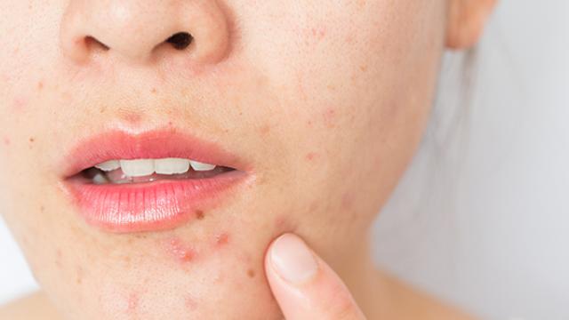 Pessoa com acne tocando o queixo, mostrando manchas vermelhas no rosto.